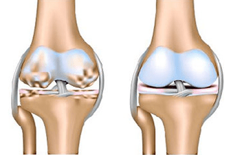 Gesond Gelenk an Arthrosis