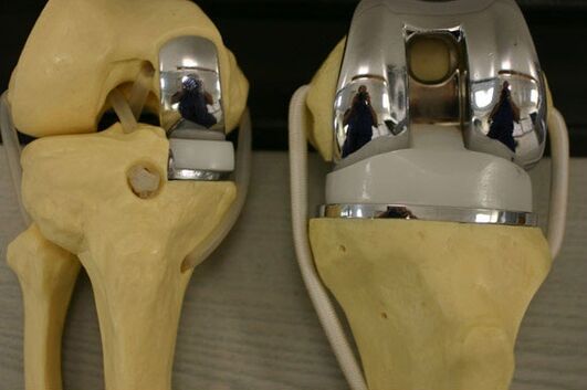 Varianten vun Endoprosthetiker vum Knie Gelenk