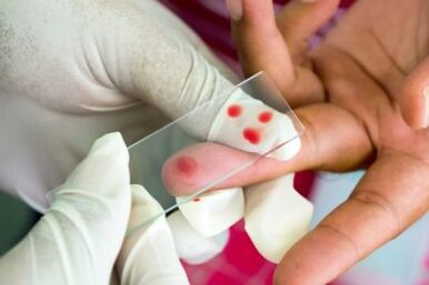 Diagnos vu Péng an de Gelenker vun de Fangeren