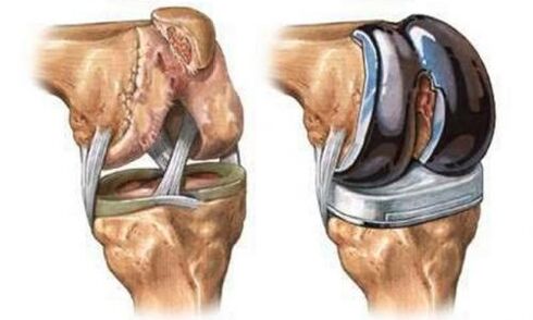 Endoprosthetiker vum Knie Joint fir Arthrosis