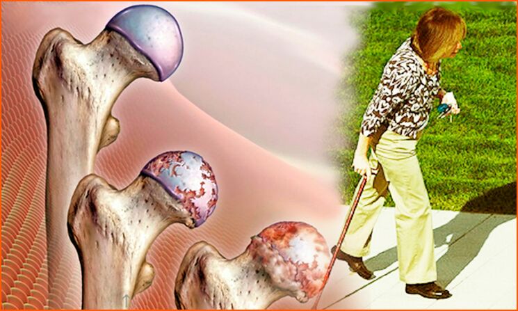Persistent Lähmung an der leschter Stuf vun der Arthrosis vum Hipgelenk