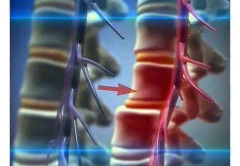 Kompressioun vun den Nervenenden an der Lendeger Osteochondrose