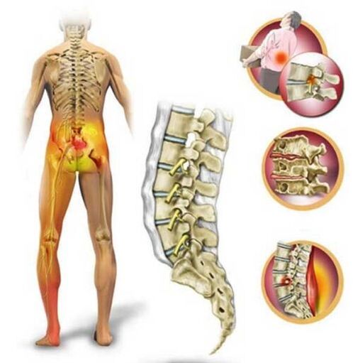 Osteochondrose vun der Lendegerwirbelsäule, verursaacht Schmerz am ënneschte Réck