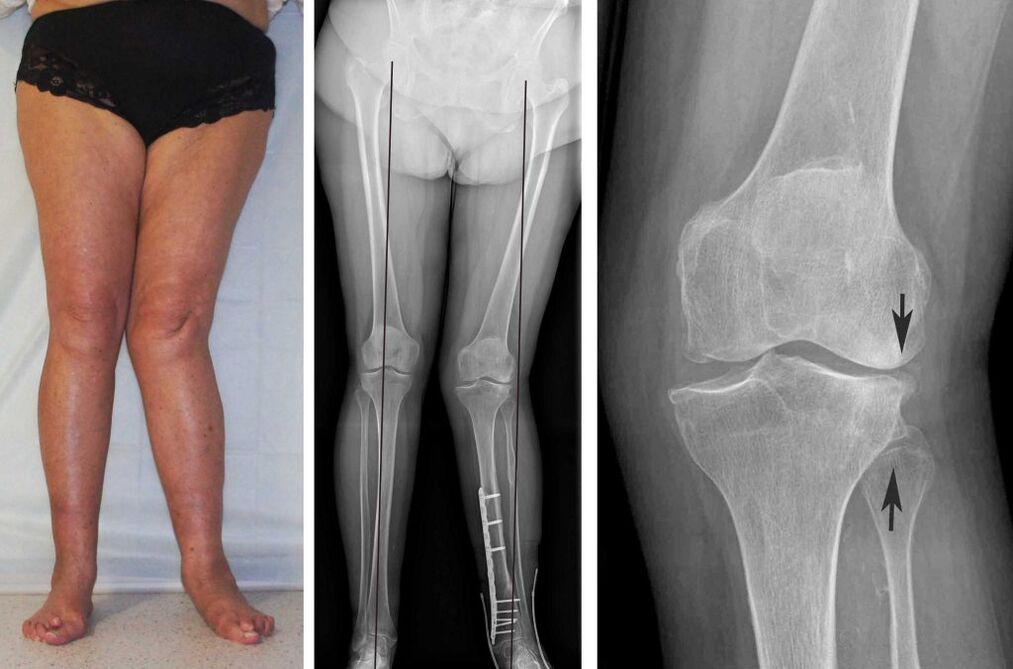 klinesch Bild vun Knie Osteoarthritis