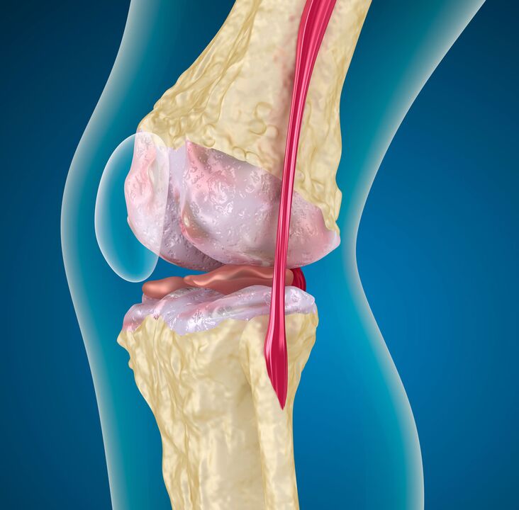 Arthrosis vum Kniegelenk - eng degenerativ-dystrophesch Krankheet