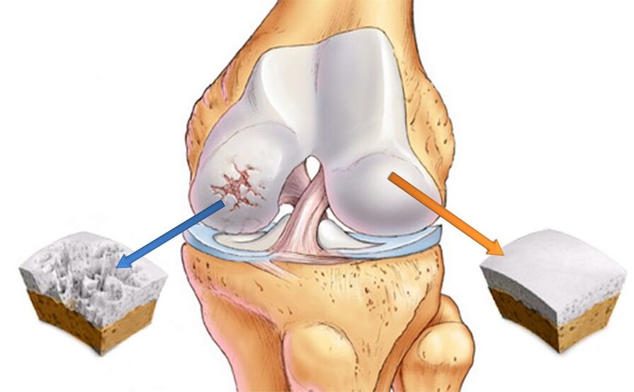 Gesond Knéi Gelenk (riets) a betraff vun Arthrosis (lénks)